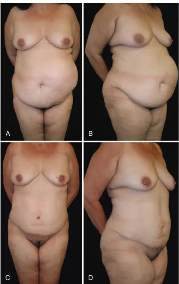 Figure 1 – In A and B, preoperative appearance.  