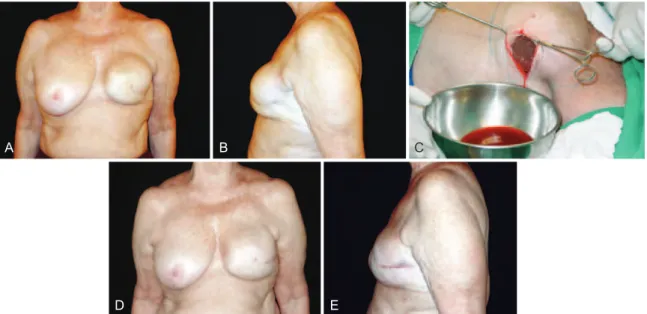 Figure 1  – A 53-year-old patient underwent bilateral adenectomy 10 years previously for ibrocystic disease and placement of smooth,  round, 250 ml silicone implants in the submuscular plane