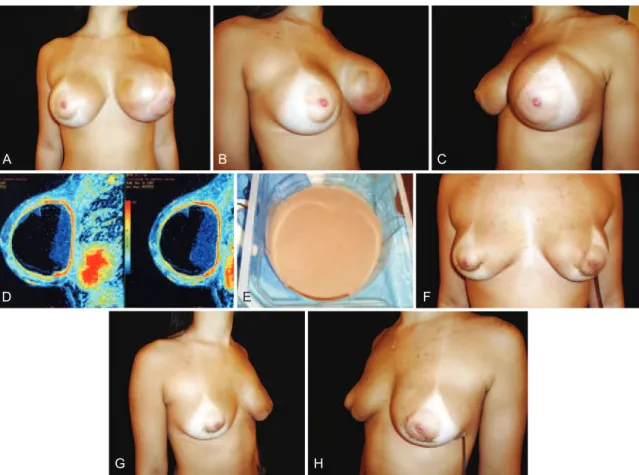 Figure 3  – A 22-year-old patient underwent placement of high-proile 245 ml polyurethane implants 1 year previously in the retroglandular  plane for esthetic purposes