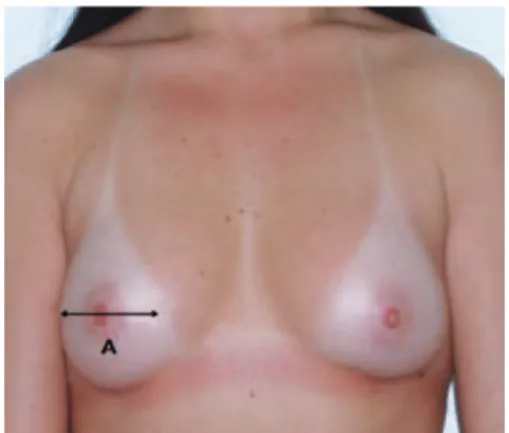 Figure 6 – Measurement B, which corresponds to the distance   from the sternal notch to the superior margin of the areola,  