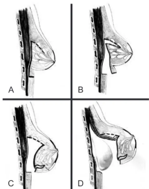 Figure 1 – Schematic drawing of the procedure used to  correct breast inferior pole hypoplasia