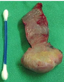 Figure 3 – Keyhole subtotal glossectomy, with gothic   arch-shaped extensive resection of the tongue ends.