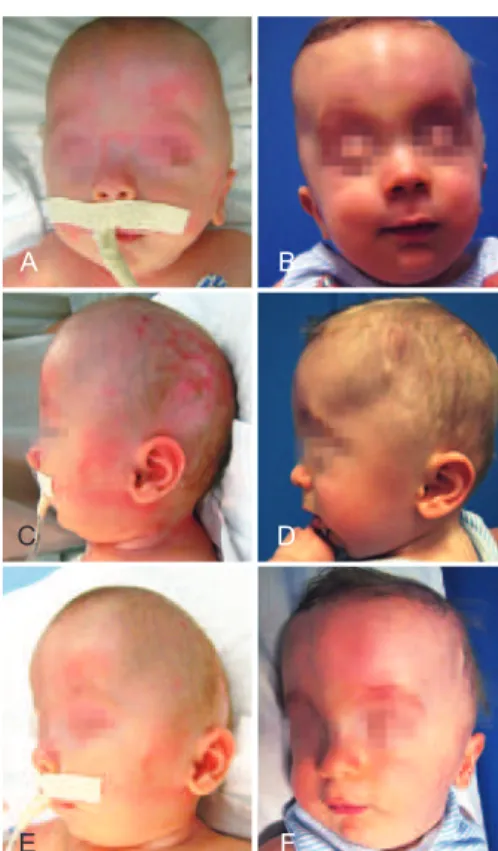 Figure 2 - Patient with turricephaly. In A, lateral preoperative  computed tomography of the skull