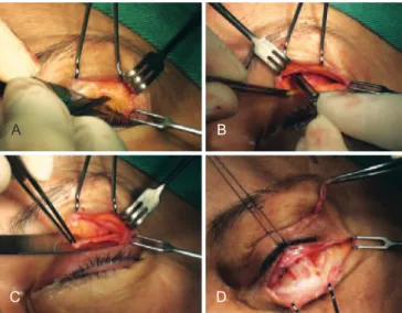 Figure 3 – In A, creation of a tunnel between the orbicularis  muscle and the lateral canthal ligament; In  B, transposition of the  lap to the lower eyelid; In C, attachment of the lap near the tarsus; 