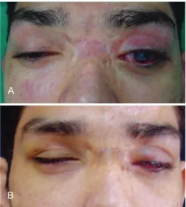 Figure 6 – A patient with posttraumatic buphthalmos   and insuficient occlusion of the left eyelid who underwent lateral 