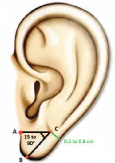 Figure 1 – Appearance ear lobe with atrophy and sagging,   showing earring hole with vertical aspect.