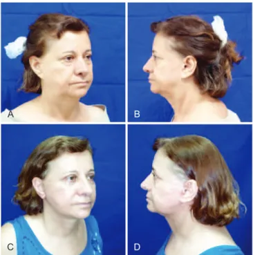 Figure 7 – In A and B, preoperative appearance of secondary  rhytidectomy associated with rejuvenation of the earlobe,   pulled aspect of the lobe, respectively, in right oblique position and 