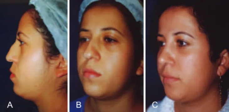 Figure 3 – Case 2. In A and B, appearance 5 years after  rhinoplasty and structured fat grafting in the