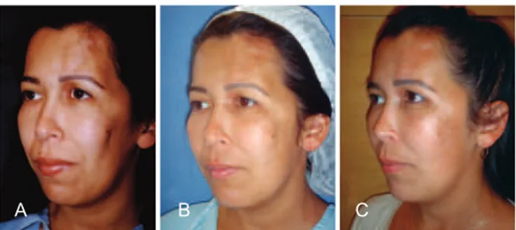 Figure 7 – Case 6. Patient presenting with excess grafting,  especially in the periorbital region, which was visible 