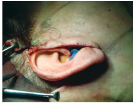 Figure 1  – Detailed view of the cervicofacial skin lap dissected  according to the marked limits and pulled with 1 temporary ixing 