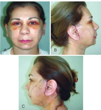 Figure 6 – Appearance on the irst postoperative day   (absence of ecchymoses and hematomas).