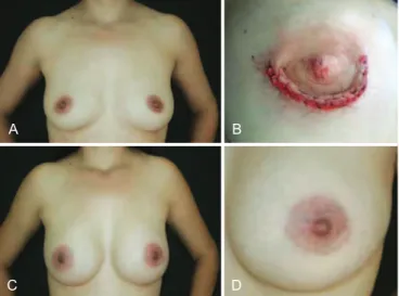 Figure 2  – In  A , presurgical appearance. In  B , presurgical marking. In  C , details of the incision during surgery