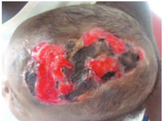 Figure 3 – Granulation tissue in the lesion region 10 days   after the micro-perforations were made.