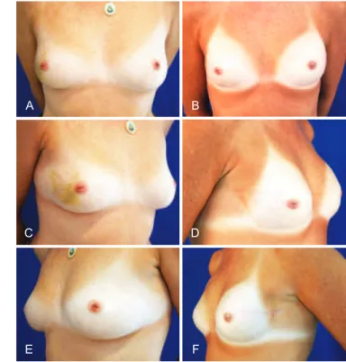 Figure 3 – Mastectomy in the left breast and breast reconstruction  with expander prosthesis, mastopexy, and prosthesis placement in 