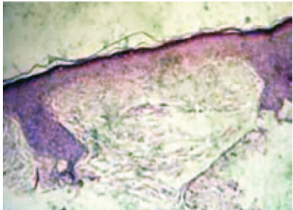 Figure 4 – Case 2. Result of the histological examination of a  sample obtained during cheiloplasty, showing a thin epidermis with 