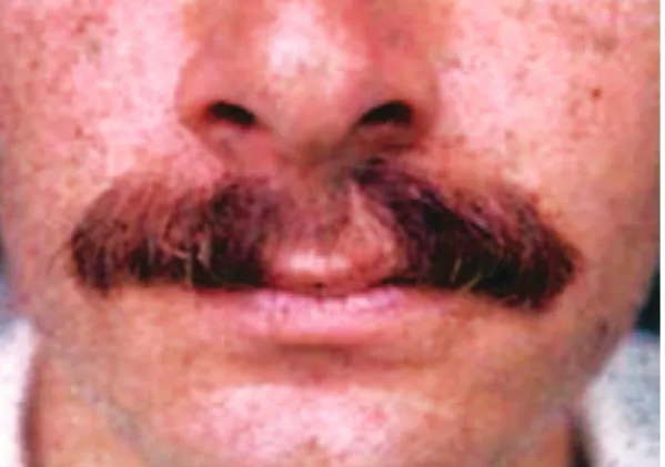 Figure 10  – Case 5. Result of the histological examination result  showing a thin epidermis and the absence of dermal papillae.