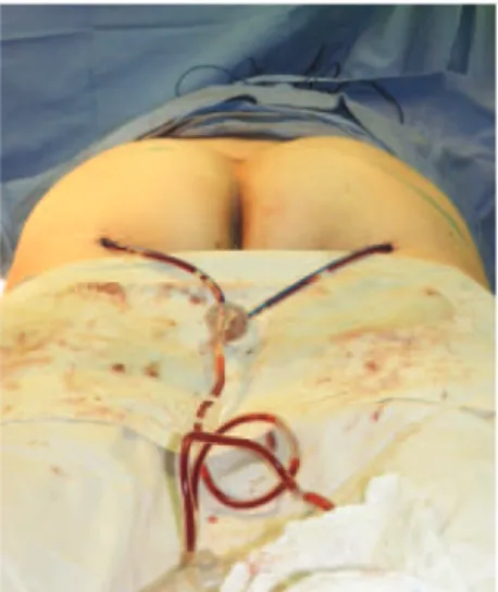 Figure 5 – Flap being ixed to the aponeurosis   after being rotated 180°.
