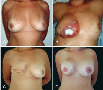 Figure 5 - In A, techniques used in salvage breast reconstructions. 