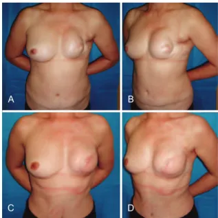 Figure 9 – In A and B, postoperative appearance of right  mastectomy with reconstruction using TRAM that progressed  to necrosis