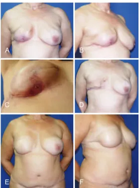 Figure 13 – In A and B, appearance 2 years after left mastectomy  and reconstruction using LDMF and a prosthesis that resulted in 
