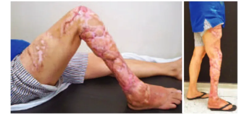 Figure 3 – Postoperative appearance 12 months   after surgery with muscle laps and skin grafts.