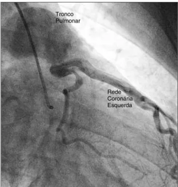 Figura 2 - Artéria coronária esquerda na fase final de injeção do contraste via artéria coronária direita, opacificando a porção proximal do tronco pulmonar.