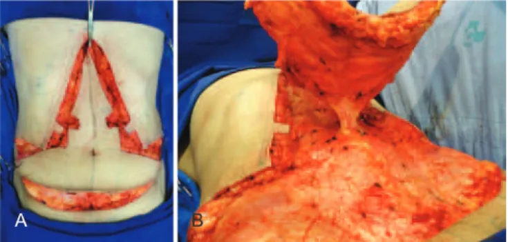 Figure 3 – Intraoperative appearance after the resection  of excess skin and amputation of the umbilicus pedicle at its base, 