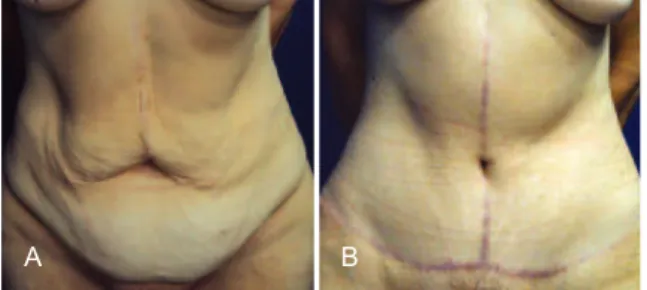 Figure 10 – Distances of 16.5- and 18-cm   from the xiphoid to the neo-umbilicus.