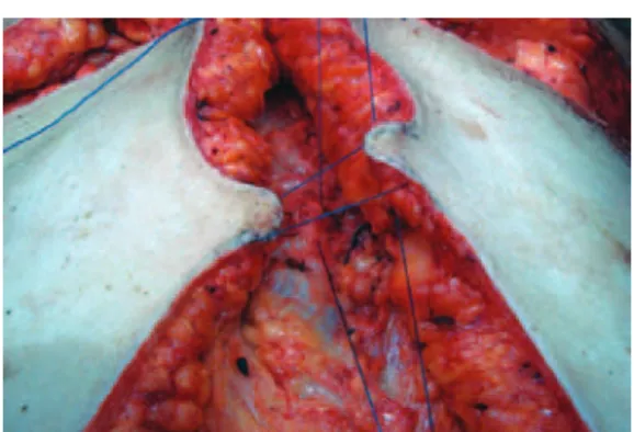 Figure 4 – Flaps ixed at the aponeurosis,   forming the base and groove.
