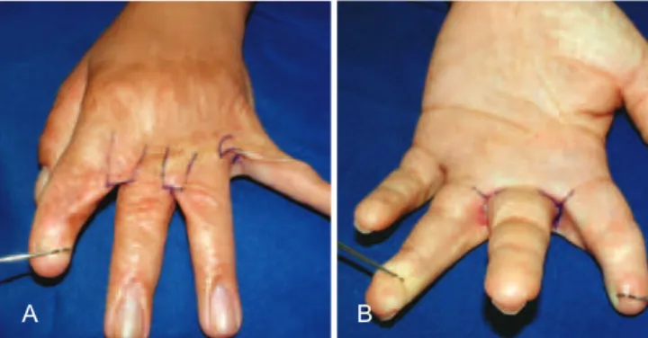 Figure 2 – Dorsal lap marked on the second and third interdigital  spaces between the ring and little ingers, delimiting Z-plasty.