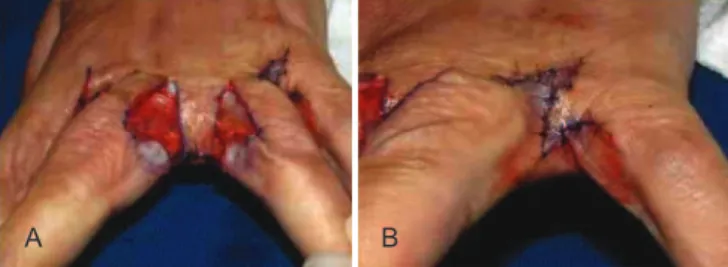 Figure 5 – Appearance 12 months postoperatively, showing  complete restoration of the commissures and digital correction of the 