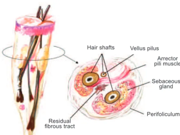 Figure 6 – The procedure for implantation of 1,500 units follicle  takes about 2 hours