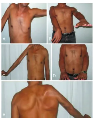 Figure 1 – In A and B, preoperative appearance showing shoulder  limitation and the inability to extend the wrist, hand, and ingers