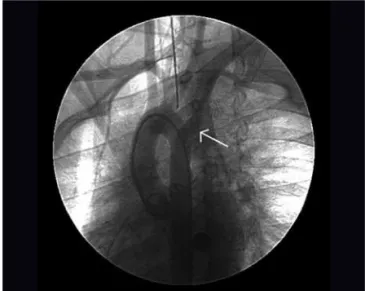 Figura 1 - Arco aórtico direito com divertículo de Kommerell. APD = artéria pulmonar direita; APE = artéria pulmonar esquerda; CD = artéria carótida direita; CE = artéria carótida esquerda; divertículo aórtico = divertículo de Kommerell; ES = esôfago; PCA 