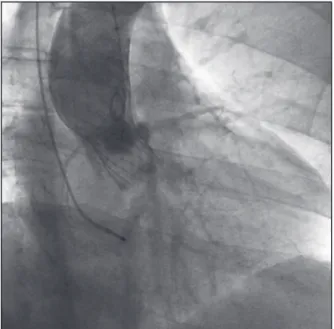 Figure 2 – Aortography showing the Edwards SAPIEN TM  XT prosthesis  in the aortic position without regurgitation.