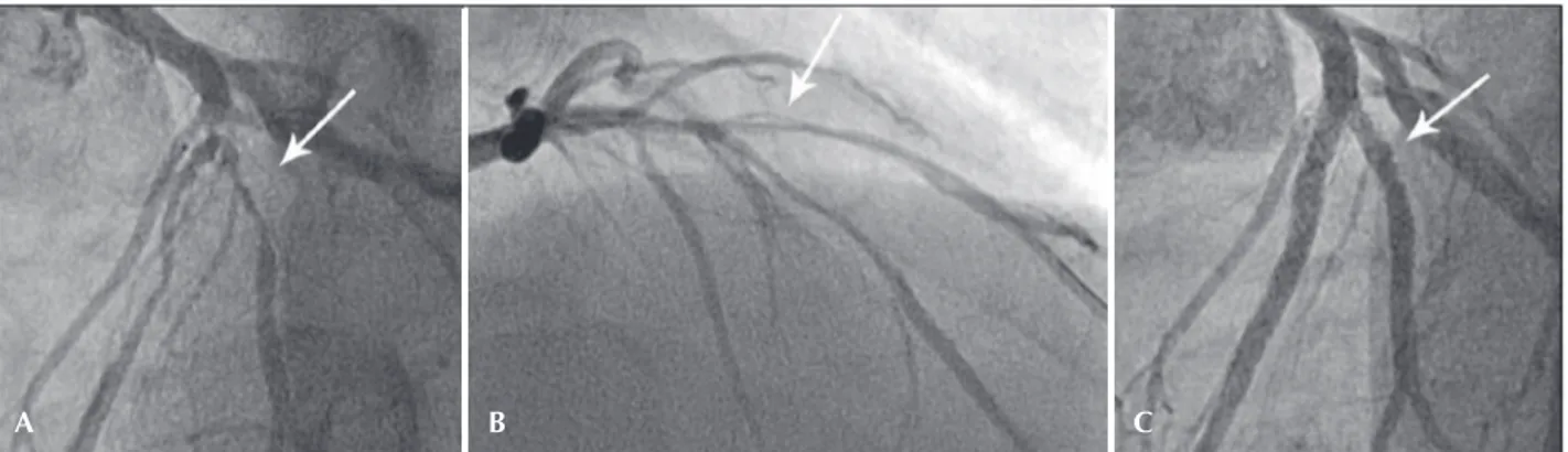 Figure 2 – Image of a ‘true’ coronary bifurcation lesion located in the proximal segment of the anterior descending artery (A), which showed dissection  of the diagonal branch after predilation with a balloon-catheter (B), treated with a 2-stent (mini-crus
