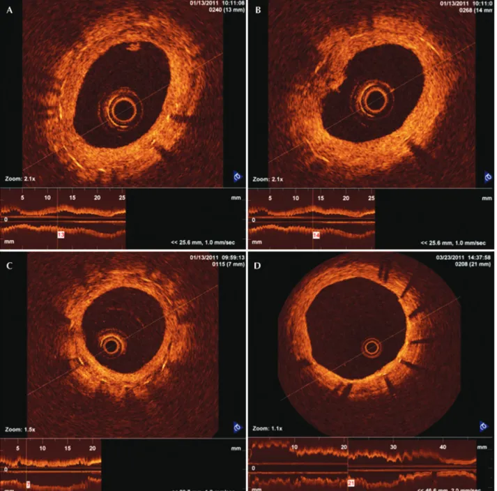 Figure 1 – Optical coherence tomography images of a cross-section of porcine coronaries with DES
