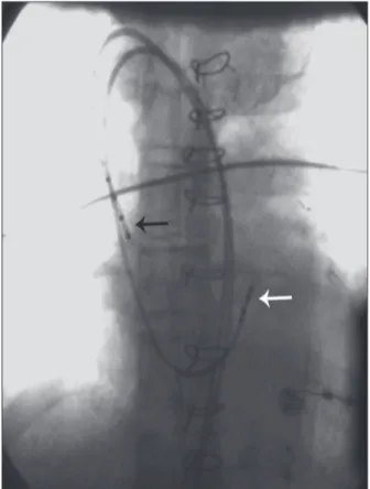 Figure 3 – Positioning of diagnostic catheters in the right atrium (black  arrow) and His bundle region (white arrow).