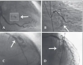 Figure 1 – In A, the left circumflex artery with an extraluminal crater (type I   Ellis perforation)