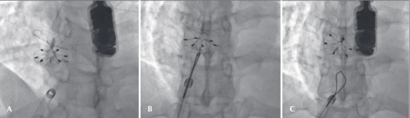 Figure 3 – Details of the implant. A, Prosthesis positioned in the atrial septum, completely configured but still attached to the delivery system