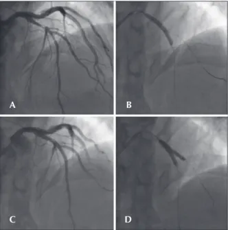 Figure 1 – In A, the initial angiogram demonstrating 80% lesion in  the left anterior descending artery with an image that is suggestive of  intracoronary thrombus