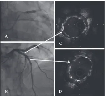 Figure 2 – In A, angiographic control after the kissing balloon. In B,  inal angiographic control without the guidewire in the diagonal branch  demonstrating an equivocal image in proximal stent border (arrow).