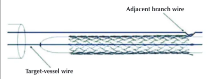 Figure 1 – Schematic representation of stent preparation for the Szabo  technique using two 0.014-inch guidewires