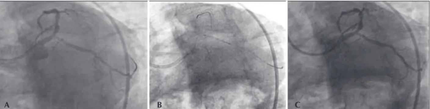 Figure 2 – A: Presence of a severe lesion at the origin of the circumlex coronary artery