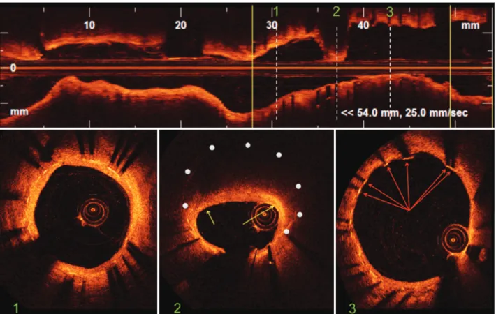 Figure 2 – Optical coherence tomography. In the top panel, longitudinal reconstruction of the left circumflex artery
