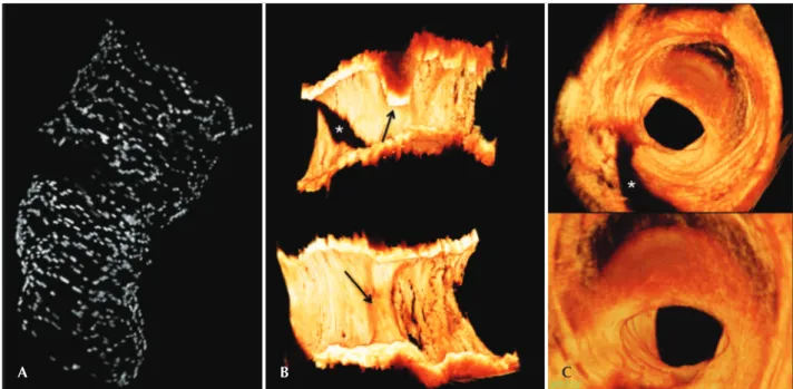 Figure 3 – Three-dimensional reconstruction of optical coherence tomography images. In A, three-dimensional reconstruction of the stent revealing  discontinuity of the stent structure at the site of restenosis through important attenuation of the optical s