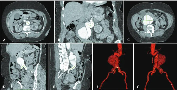 Figure 1 – Angio-tomography showing a three-dimensional multi-planar reconstruction of a complex aortic aneurysm