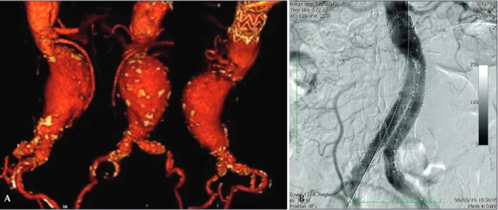 Figure 2 – A shows an angio-tomography of the complex abdominal aortic aneurysm with a proximal aneurysm neck angle &gt;  60  degrees and aor- aor-toiliac bifurcation &gt;  90  degrees