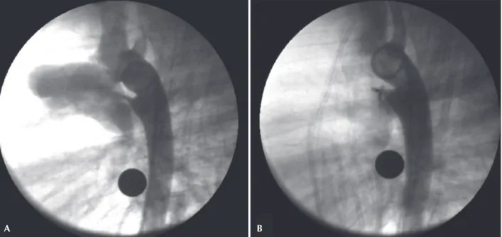 Figure 2 – Ductus arteriosus type A with a 2 mm diameter at the pulmonary extremity. A 4 mm Amplatzer ®  Vascular Plug II device was successfully  employed