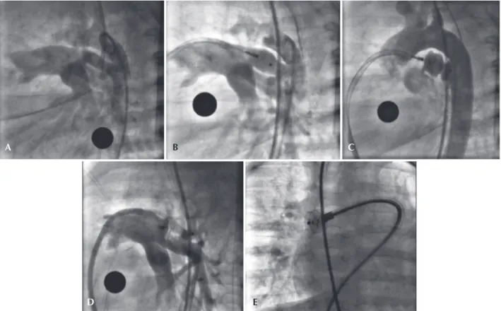Figure 5 – Tubular ductus arteriosus type C, of high low, with 5.5 mm diameter at both ends